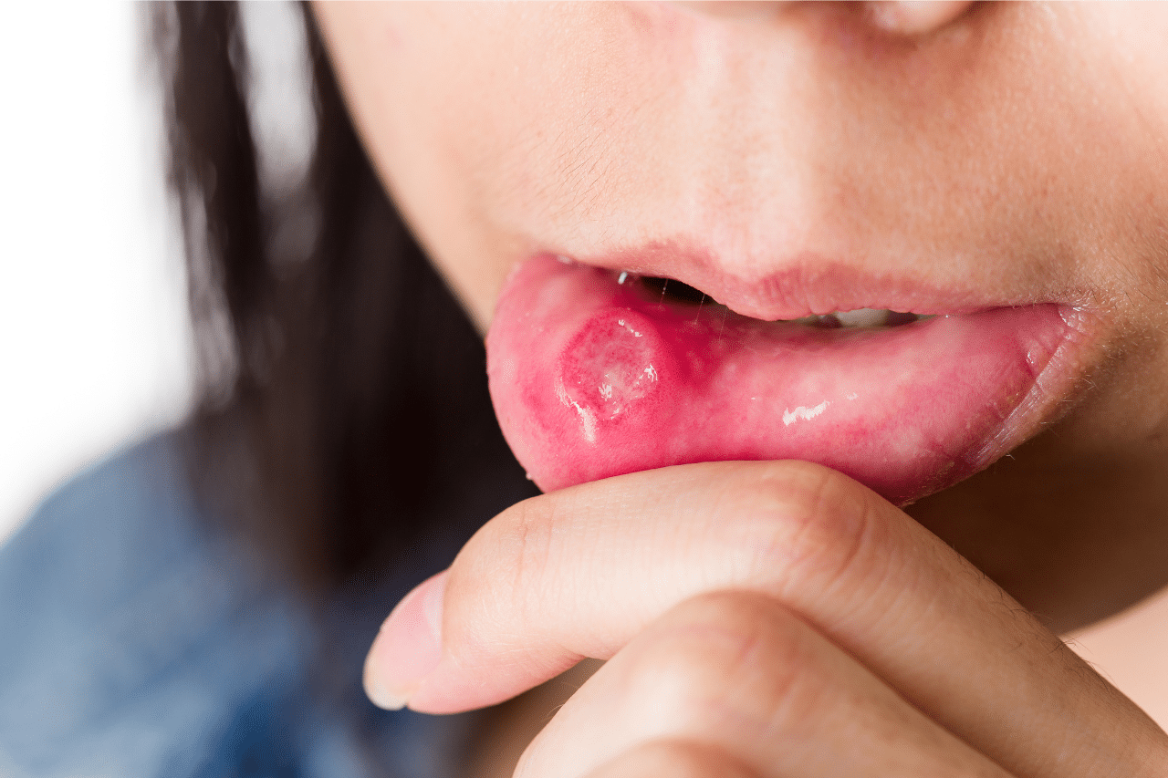 afta suussa - näin hoidat sen kotona